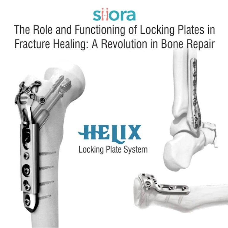 The Role Of Locking Plates In Fracture Healing Siora Surgicals