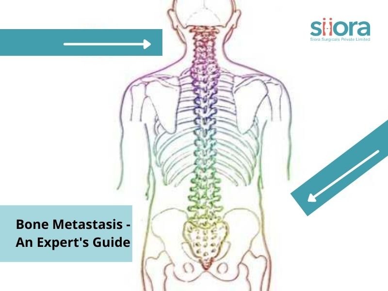 Read more about the article Bone Metastasis – An Experts Guide
