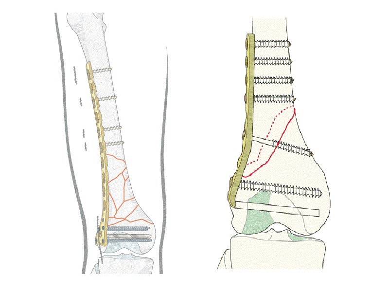 Distal Femur Thighbone Fractures of the Knee
