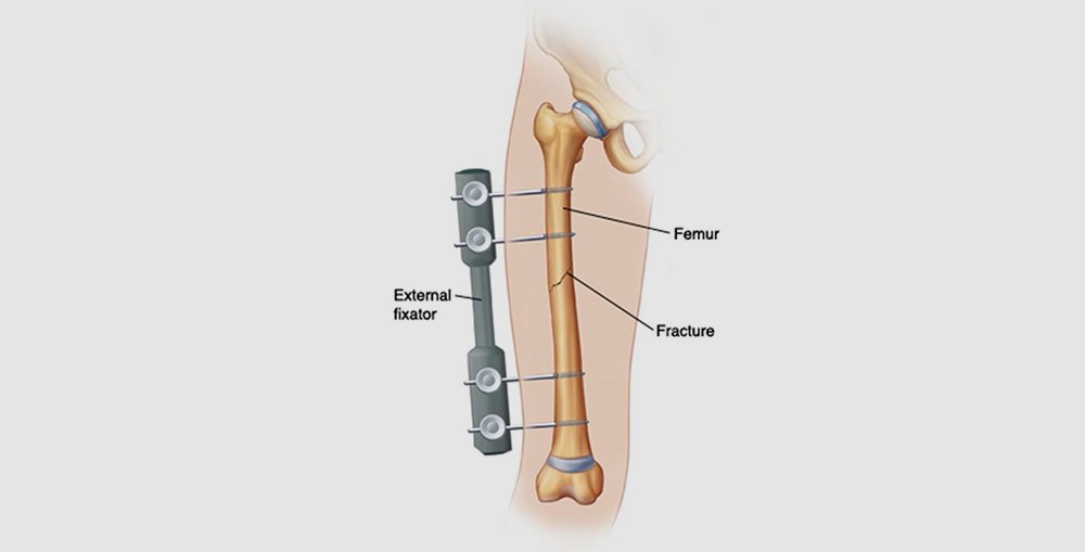 Femur Shaft Fractures Types, Cause & Symptoms