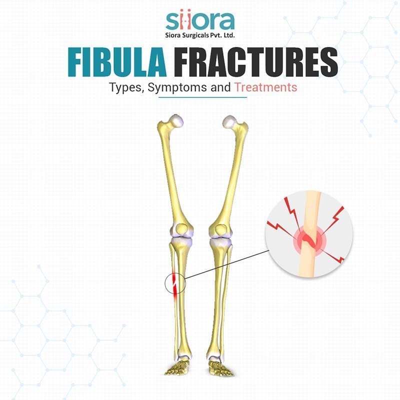 Fibula Fractures Types, Symptoms & Treatment
