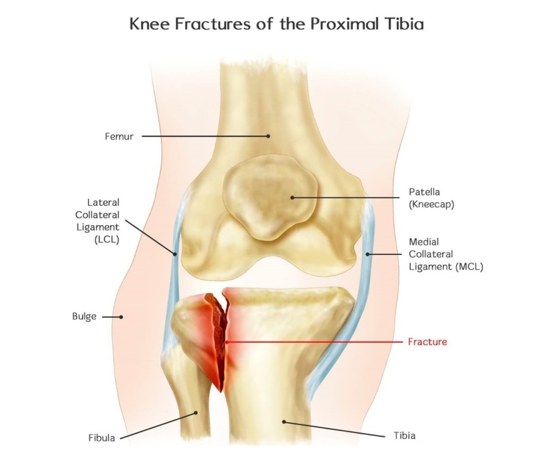 Knee Fractures Symptoms Causes & Prevention