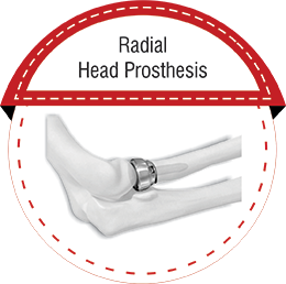 Radial Head Prosthesis