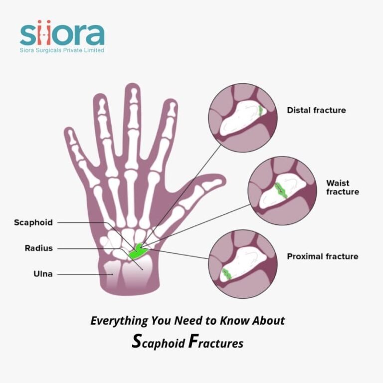 Scaphoid Fractures Everything You Need To Know About