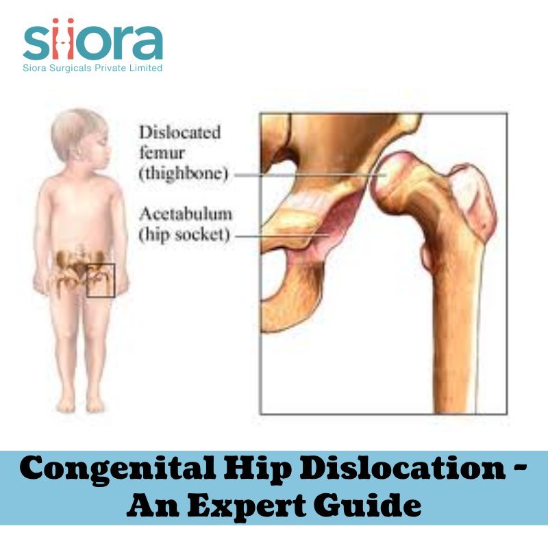 Congenital Hip Dislocation