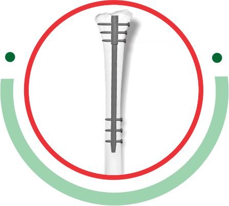 TRIFIX Supra Condylar Nailing System