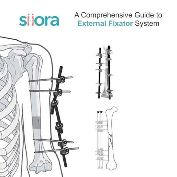 External Fixator System - A Comprehensive Guide - Siora Surgicals 