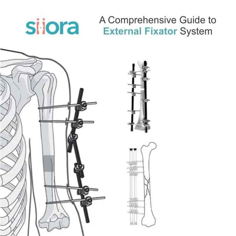 External Fixator System - A Comprehensive Guide - Siora Surgicals ...