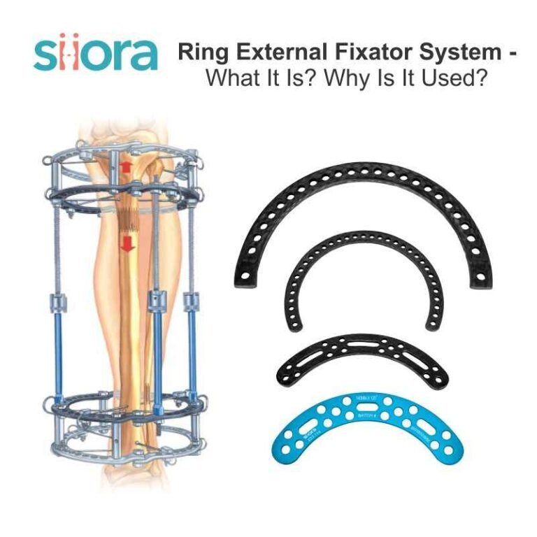 Ring External Fixator System - What It Is? Why Is It Used? - Siora ...