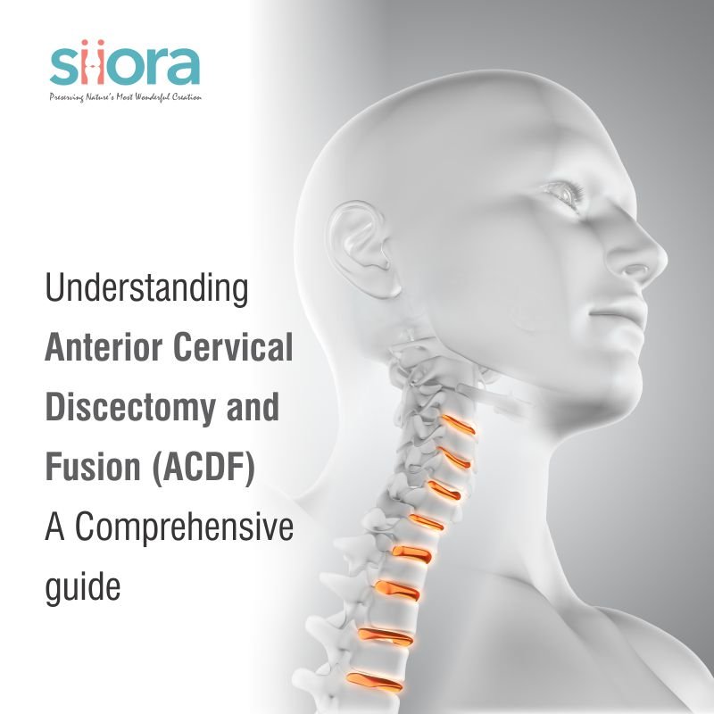 Anterior Cervical Discectomy and Fusion