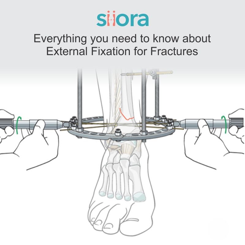 External Fixation for Fractures