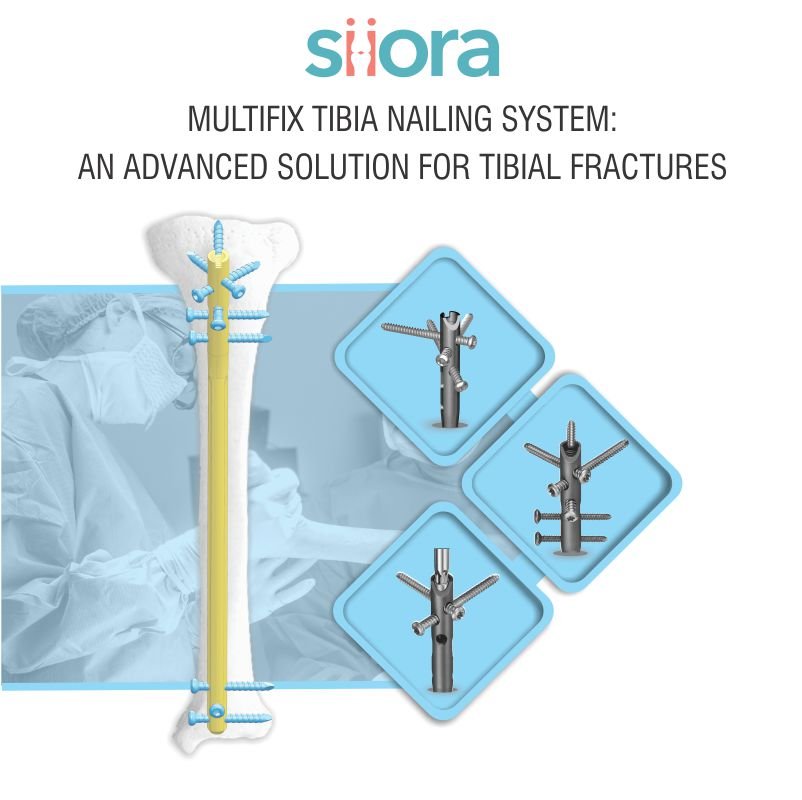 Multifix Tibia Nailing System An Advanced Solution for Tibial Fractures