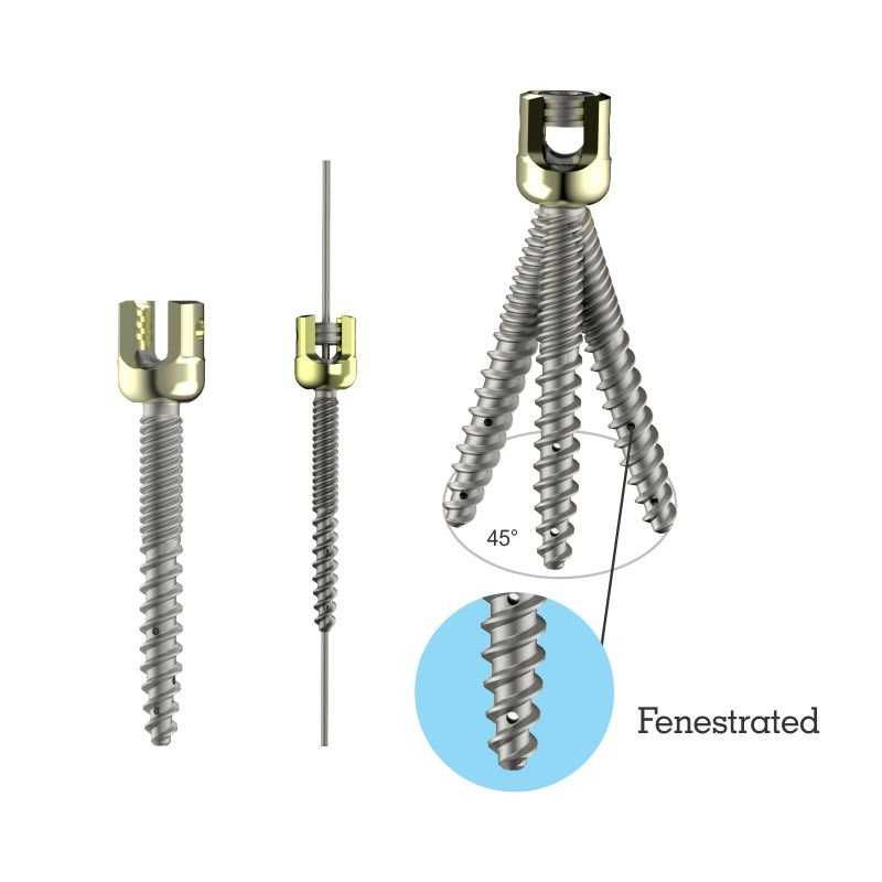 Polyaxial S-Line Dual Thread Cannulated Fenestrated Pedicle Screw