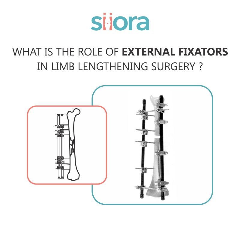 Role of External Fixators in Limb Lengthening Surgery