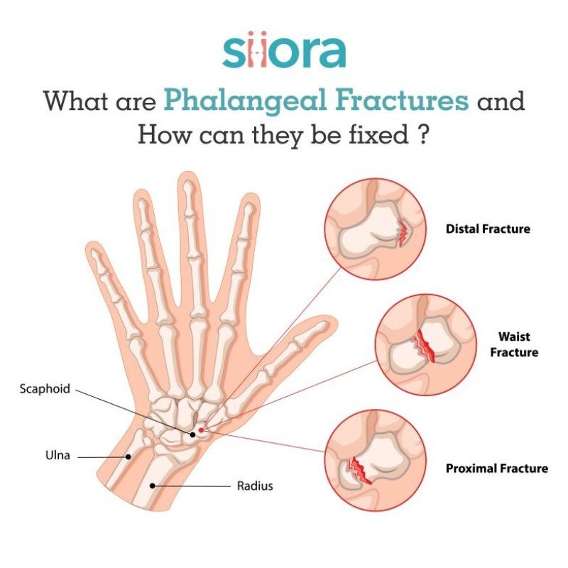 Phalangeal fractures