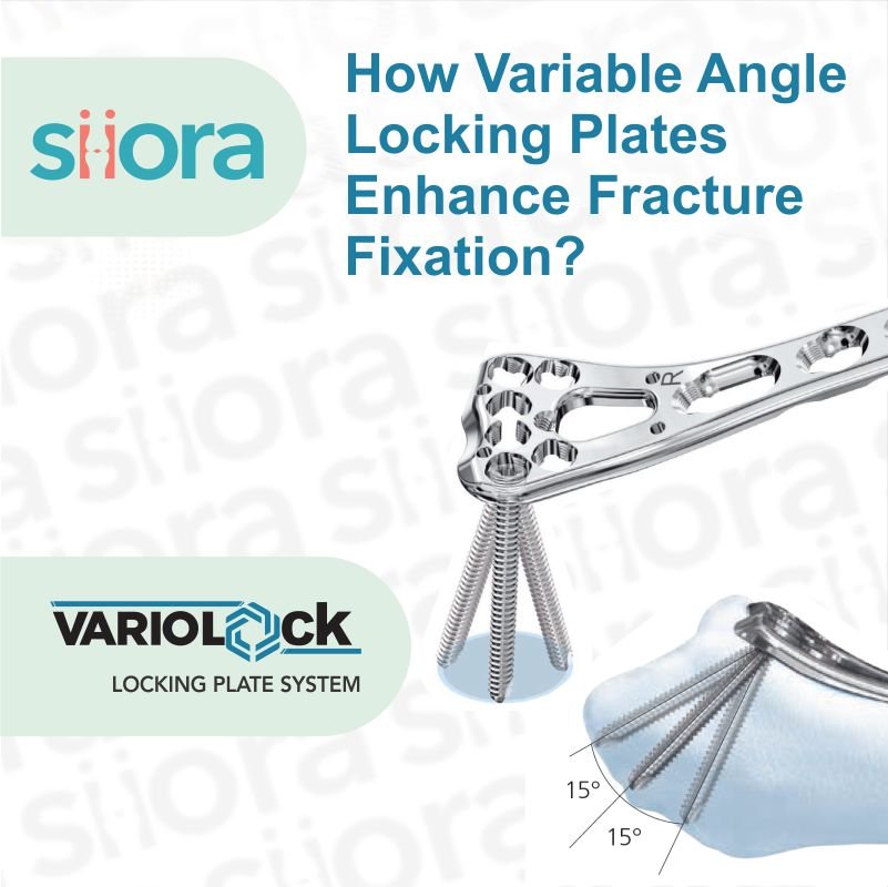 How Variable Angle Locking Plates Enhance Fracture Fixation