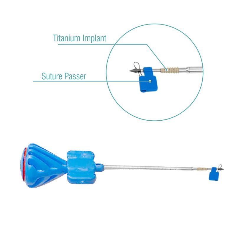 KNOTLESS Peek Screw in Suture Anchor with Titanium Tip - Sterile