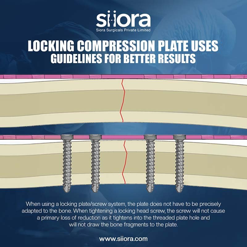 Locking Compression Plate Uses