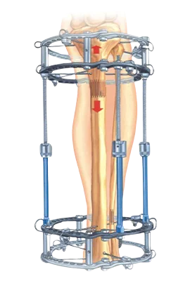 external fixation system