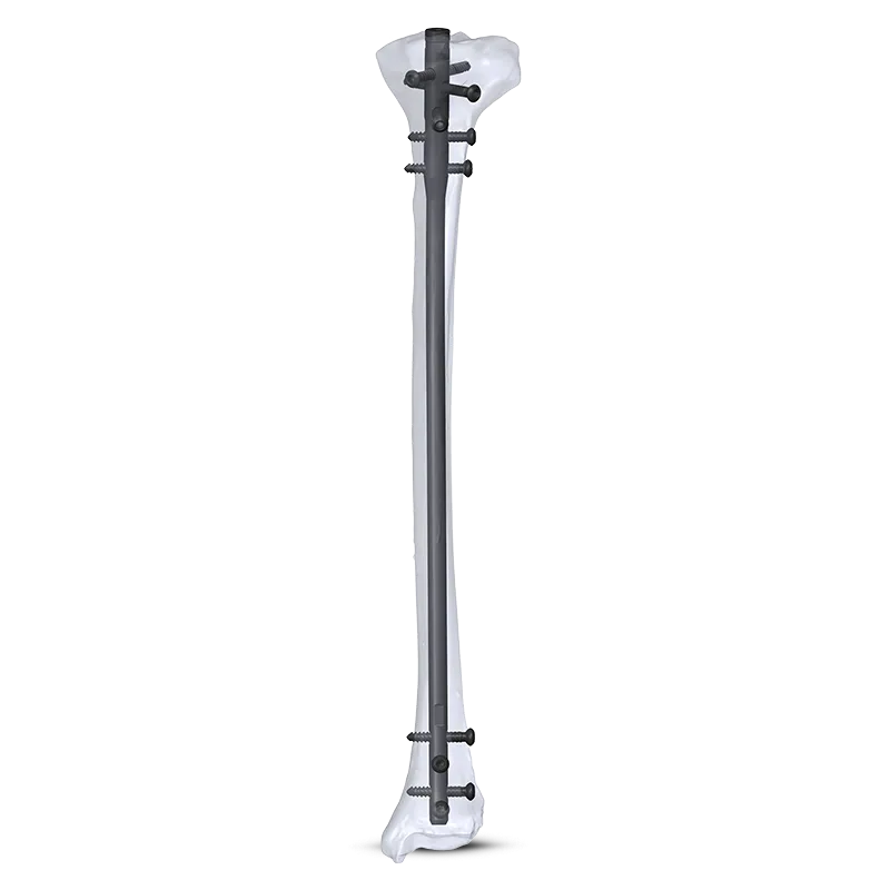 Aduera™ Expert Tibia Nailing System