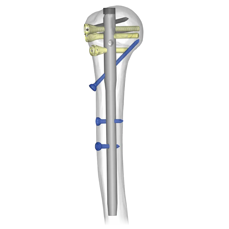 Humeron™ Multifix Humeral Nailing System
