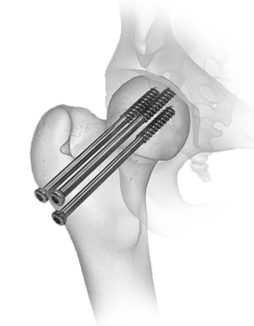 Cannulated Screws