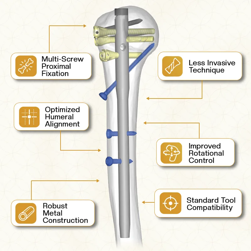 Key Features of Multi-Locking Humerus Nail
