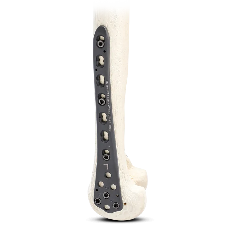 Locking Distal Femur Plate