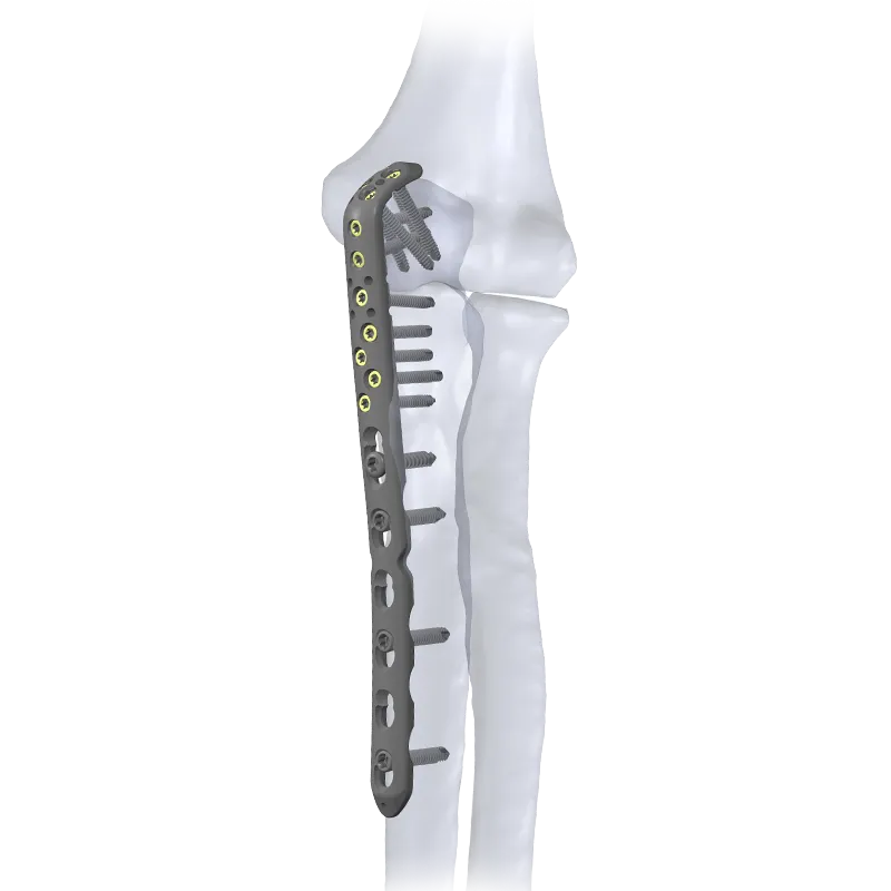 Locking Olecranon Plate with bone