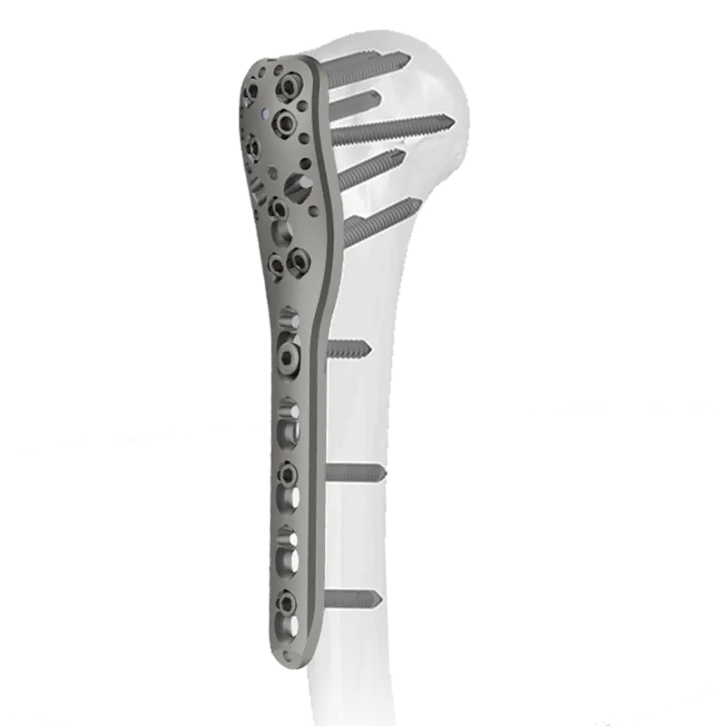 Locking Proximal Humeral Plate with bone