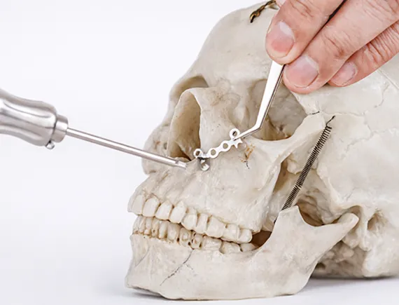 Why Choose Siora as Your Maxillofacial Implants Manufacturer