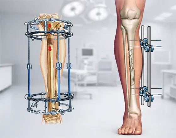 Why Siora Should be Your Top Choice as a Bone External Fixation System Manufacturer