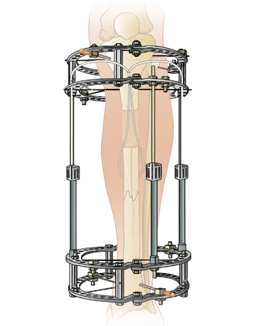 External Fixation