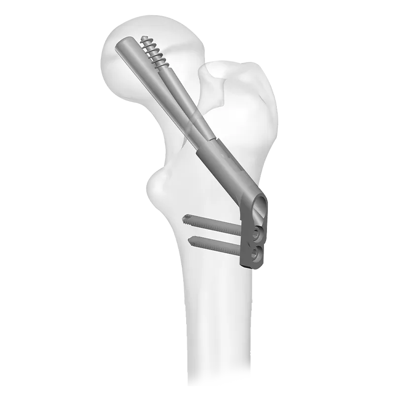 Femoral Neck Fixation System
