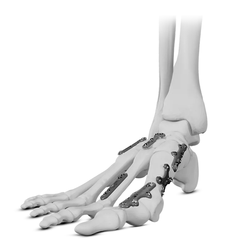 Forefoot-Midfoot-Locking-Plate-System