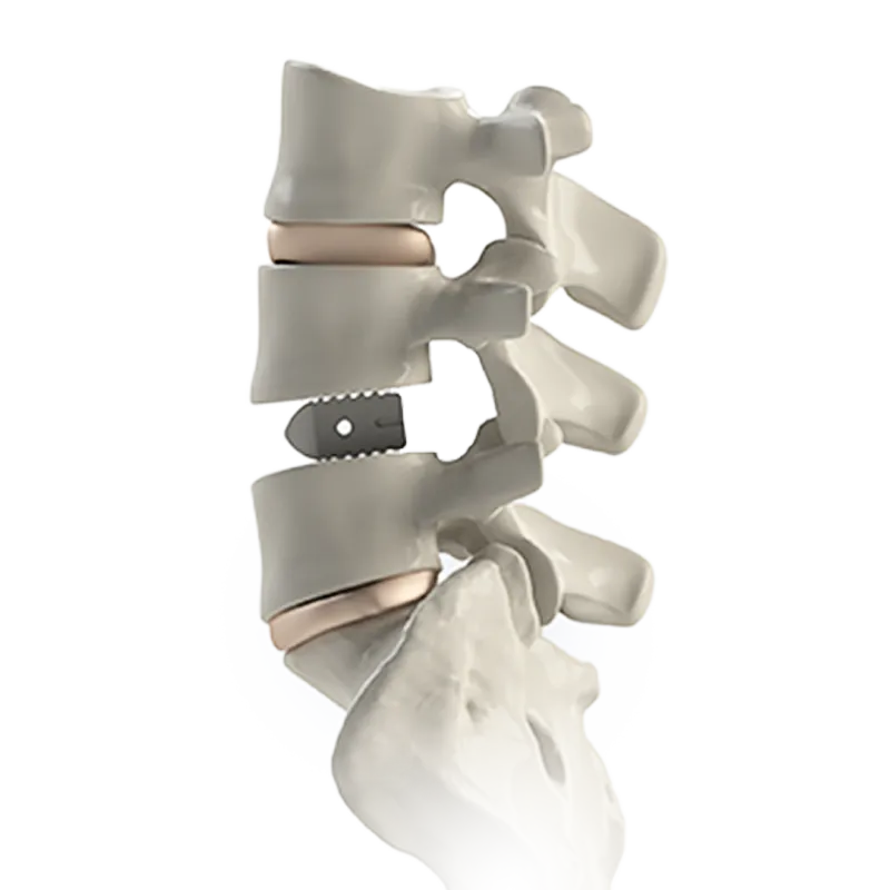 PILF Cage with bone