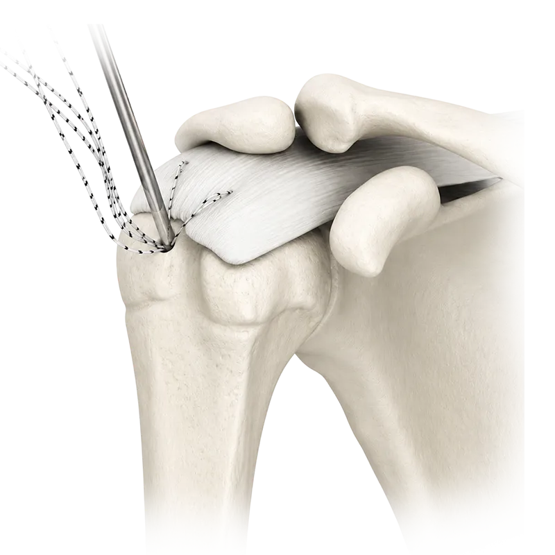 Shoulder category image