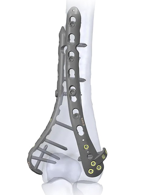 Small Fragment Locking Implant System