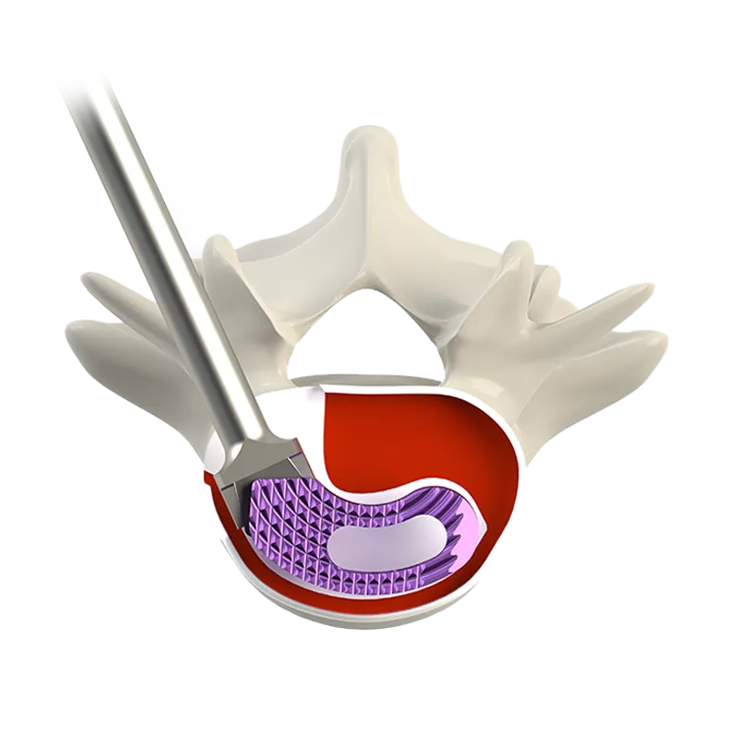 TILF Interbody Fusion Cage with Bone