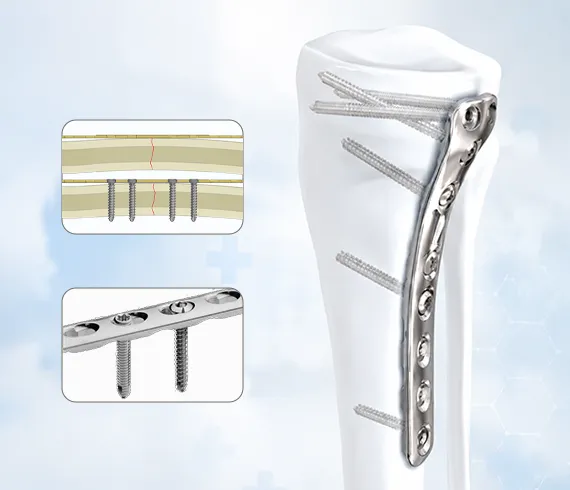 Why Choose Siora Surgicals Pvt. Ltd. for Orthopedic Small Fragment Locking System