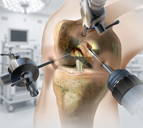 Why Choose Siora Surgicals for Sports Medicine Implants and Instruments