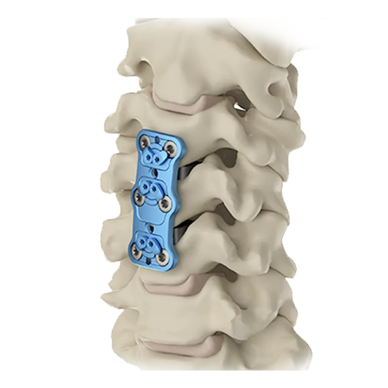 anterior cervical with bone