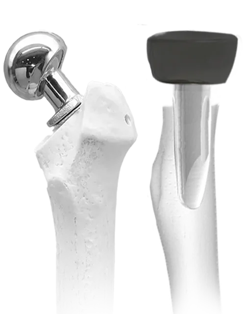 bipolar and redial head front image