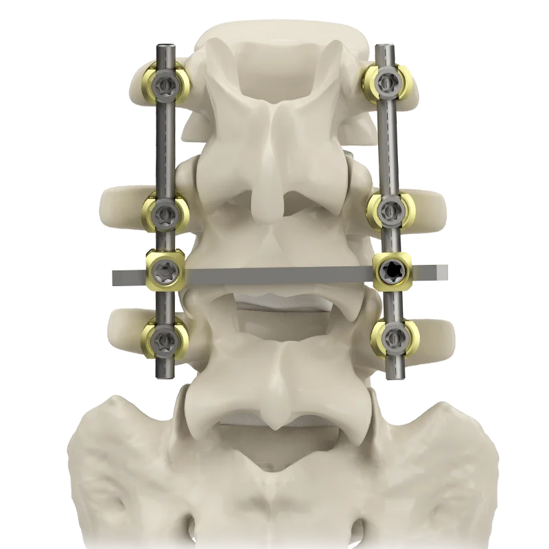 pedicle screws bone